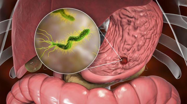 ¿Qué pasa cuando una persona tiene la Helicobacter pylori?