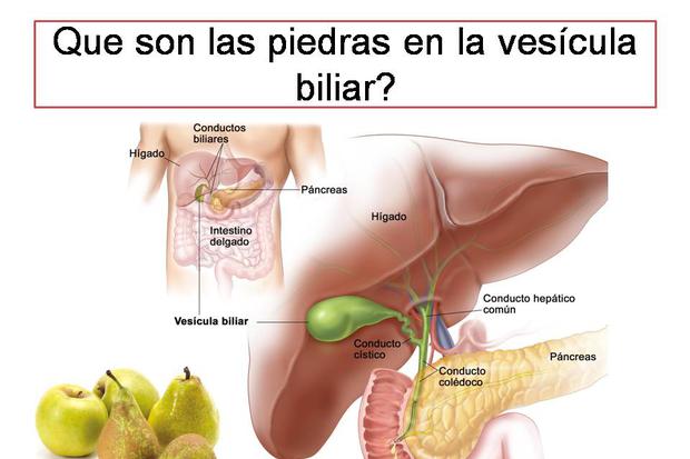 Colelitiasis o piedras en la vesícula, un padecimiento de cuidado