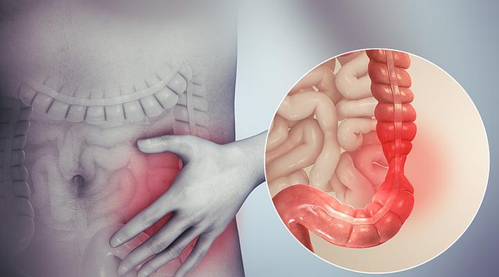 ¿Qué se siente cuando tenés intestino irritable?