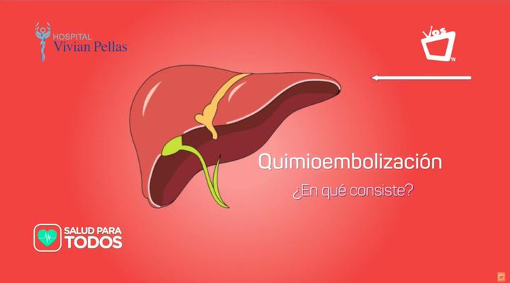 Quimioembolización para el cáncer de hígado || SALUD PARA TODOS