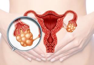 ¿Qué tan peligroso es tener ovarios poliquísticos?