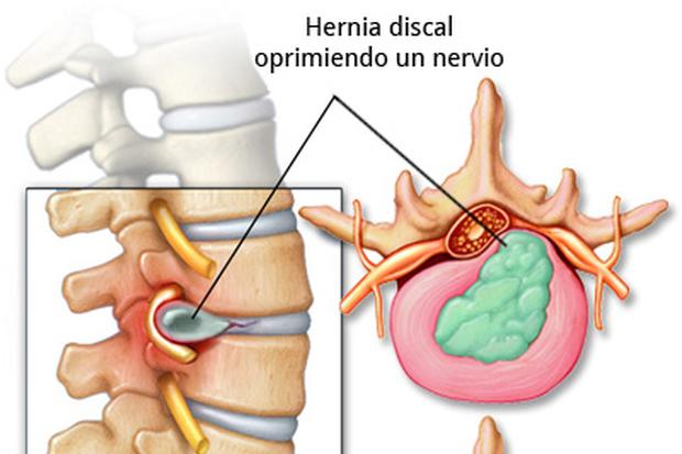 Tratamientos no quirúrgicos de las hernias de disco