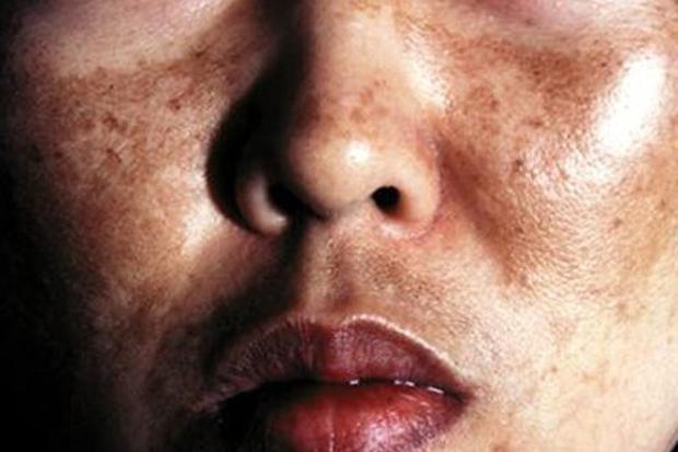 ¿Cuánto sabés del melasma o máscara del embarazo?