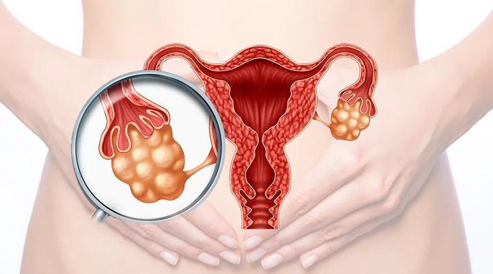 ¿Qué tan peligroso es tener ovarios poliquísticos?