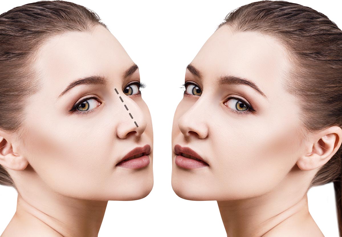 Rinoplastia, ¿una solución estética o de salud? Vos TV
