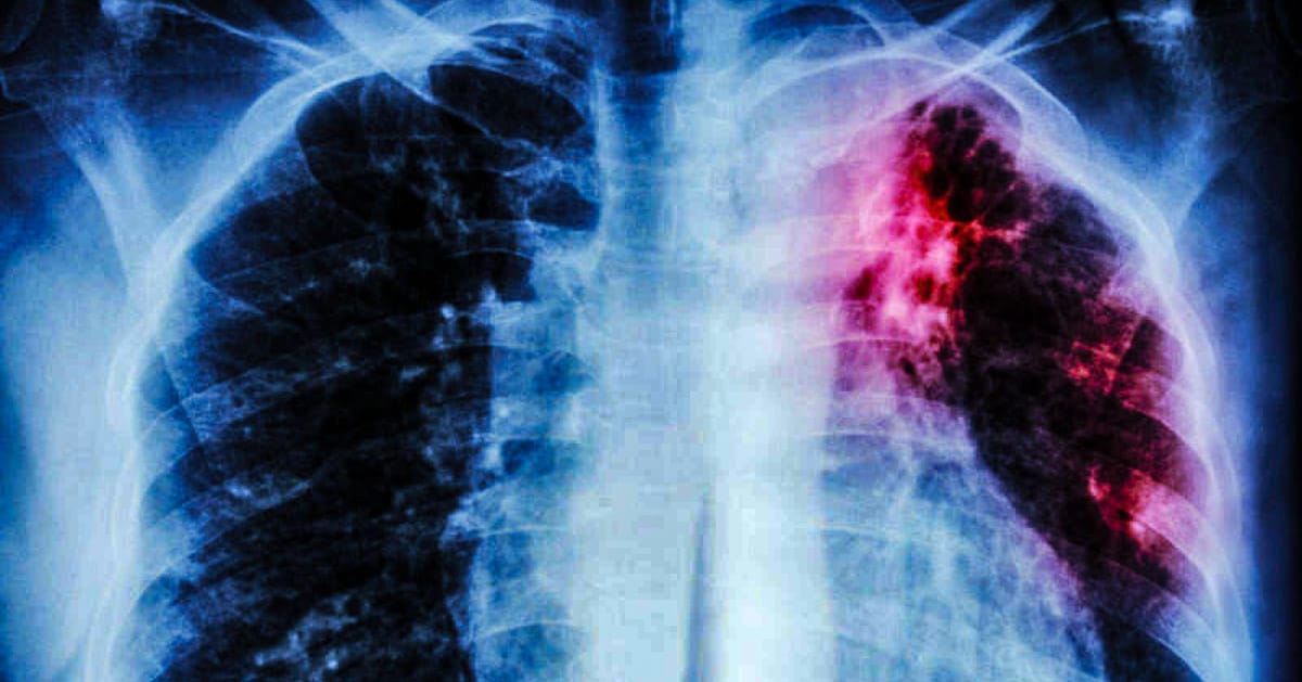 La tuberculosis se adquiere por la vías respiratorias / Cortesía
